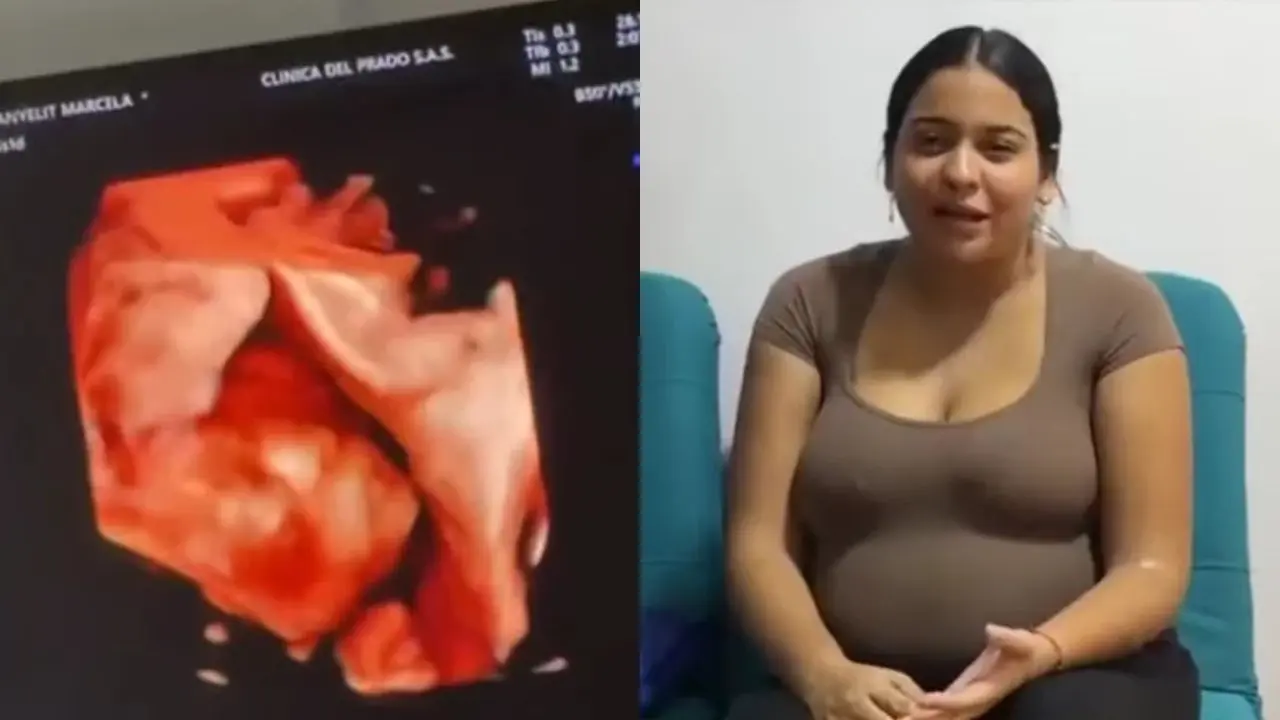 Nuevo embarazo múltiple idéntico en Caucasia, Antioquia: joven de 19 años espera trillizas